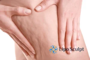 CoolSculpting for Legs: The Innovative Approach to Redefining Your Legs 5 Start your journey today book your coolsculpting treatment Camberley online today!